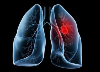 کشف روشی برای درمان یکی از مرگبارترین انواع سرطان ریه